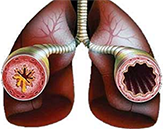 сужение бронхов при астме