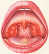 катаральная ангина