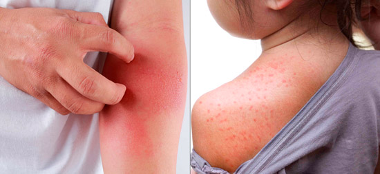 аллергическая реакция на препарат: зуд и сыпь на коже