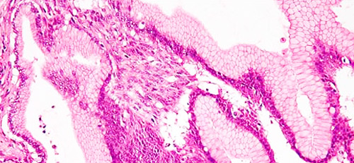 кисты поджелудочной железы - вид под микроскопом