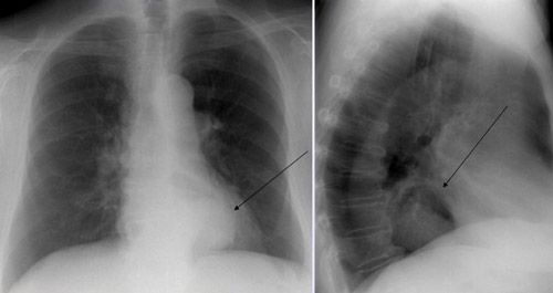 Рентгенограмма грыжи пищеводного отверстия