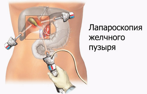 Лапароскопия желчного пузыря