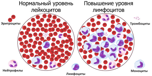 повышение уровня лейкоцитов в крови