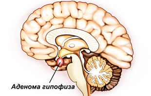 аденома гипофиза головного мозга