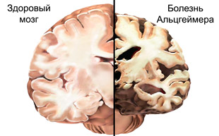 мозг здорового человека и с болезнью Альцгеймера