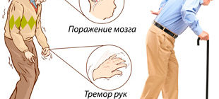 тремор рук один из симптомов болезни Паркинсона