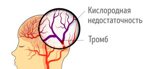 ишемический инсульт головного мозга
