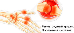 Ревматоидный артрит. Поражения суставов