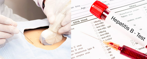 Пункционная биопсия и анализ крови на гепатит