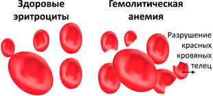 здоровые эритроциты и при гемолитической анемии