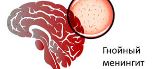 гнойный менингит мозга от проникновения бактерий