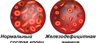 кровь в норме и железодефицитной анемии