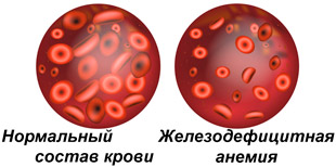 состав крови в норме и железодефицитной анемии