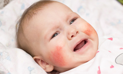 дерматит у ребенка на лице