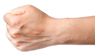кожный дерматит у взрослых
