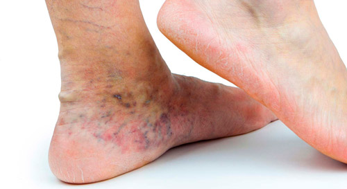 варикозный дерматит на ногах