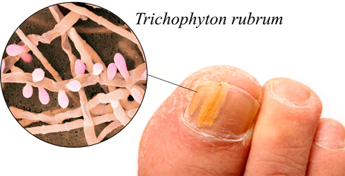 грибок Trichophyton rubrum возбудитель микоза стоп