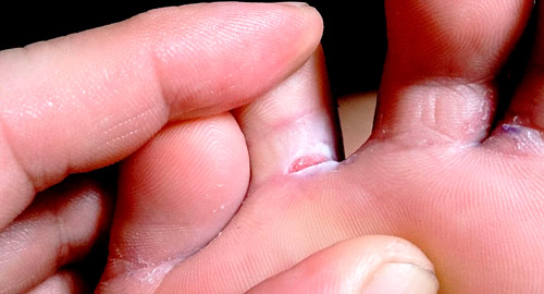 грибок между пальцев стопы 