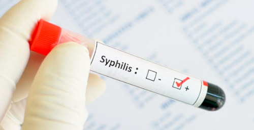 анализ крови на сифилис
