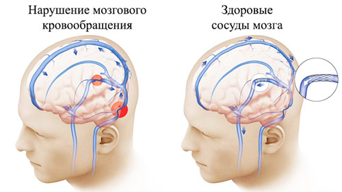 сосуды головного мозга