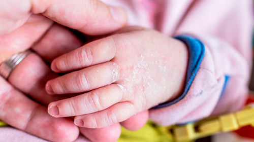 дерматит у ребенка на руках