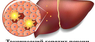 Токсический гепатит печени