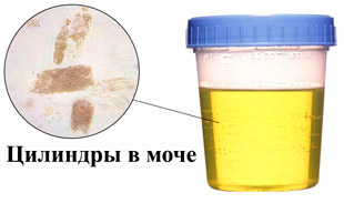 Цилиндры в моче под микроскопом